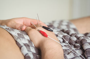 Dry-needling